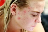 Adolescenza e acne. Mia figlia sta perdendo l'autostima. Come posso aiutarla?