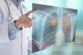 Una nuova speranza per la cura del tumore ai polmoni