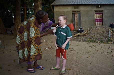 Africa. Il dilemma dei bambini albini: salvarli in loco o con l'adozione internazionale?